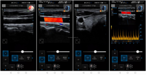 Ecógrafo Doppler Color Portátil para <span class=keywords><strong>Tiroides</strong></span> <span class=keywords><strong>de</strong></span> Alta Resolución y Eficiencia con Certificación CE e ISO - Product Image 2