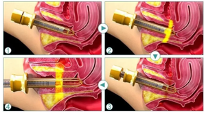 980nm 1470nm Ginecología Alemania Emisor láser Vagina Estiramiento Posparto Suelo pélvico Rehabilitación muscular Dispositivo láser - Product Image 6