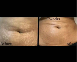 Máquina de Láser Fraccional de CO2 de 60W Directo de Fábrica para Reducción de Arrugas, Tratamiento de Cicatrices y Cuidado de la Piel - Product Image 6