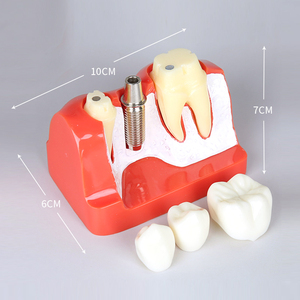 4 fois seul implant dentaire d'analyse modèle comparer avec pont logo OEM - Product Image 3