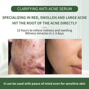 Esencia Herbal Profesional para el Acné, Material Prima para Reparación <span class=keywords><strong>de</strong></span> Marcas <span class=keywords><strong>de</strong></span> Acné y Comedones Cerrados, Venta <span class=keywords><strong>al</strong></span> <span class=keywords><strong>Por</strong></span> <span class=keywords><strong>Mayor</strong></span> - Product Image 4