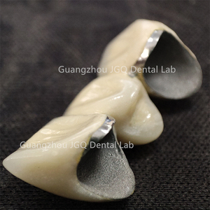 Venta caliente Dentaduras fijas <span class=keywords><strong>Precio</strong></span> <span class=keywords><strong>de</strong></span> fábrica Porcelana fundida a dientes <span class=keywords><strong>de</strong></span> metal Restauración dental <span class=keywords><strong>de</strong></span> alta calidad - Product Image 3