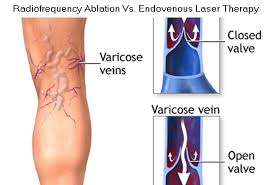Eliminación de Telangiectasias, Arañas Vasculares y Varices con <span class=keywords><strong>Láser</strong></span> Vascular de 980nm y 1470nm, Ablación Vascular EVLA EVLT - Product Image 6