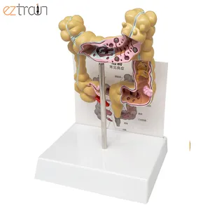 Large intestine pathological model Colon lesion model Medical anatomical model