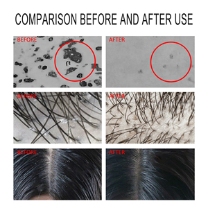 Shampooing antipelliculaire au disulfure de sélénium très efficace 500ml crème moelleuse rafraîchissante anti-frisottis pour cheveux gras savon chimique - Product Image 3