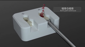 Perangkat Fusi <span class=keywords><strong>Interbody</strong></span> Lumbar Ortopedi Posterior Kelas III Berlabel CE Fule, Garansi Lebih Dari 5 Tahun, Material PEEK - Product Image 6