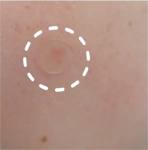 Adesivo para Acne Personalizado Coreano com Ácido Salicílico Vegano Invisível e Hidrocolóide para Rosto - Product Image 2