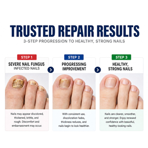 Wangtailin 30ml Líquido Reparador de Hongos en las Uñas, Tratamiento para Onicomicosis, Solución para el Alivio del Olor de Pie de Atleta - Product Image 3