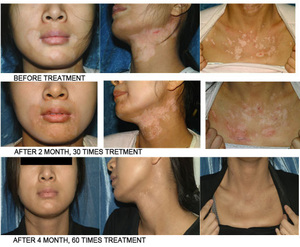 Ce thông qua Nhà máy cung cấp cầm tay UVB quang trị liệu 311 ban nhạc hẹp UVB Đèn trị liệu cho bệnh vẩy nến bệnh bạch biến - Product Image 4