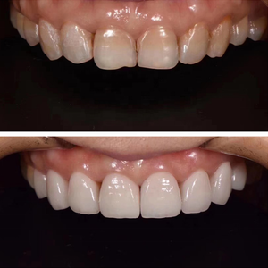 Fabricante de bloque de Zirconia Dental, disco de cerámica de vidrio de disilicato de litio Dental LT HT, lingotes de prensa de 16 colores para carillas - Product Image 6