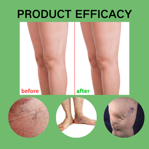 Persönliches Körperpflege-Spray gegen Krampfadern mit Aloe Vera für Beinvenen und Besenreiser Anti-Falten Beruhigend & Feuchtigkeitsspendend gegen Rötungen - Product Image 4