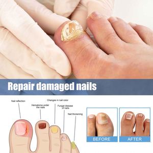 XIMONTH Soin des ongles Anti-fongique Naturel à base de plantes <span class=keywords><strong>Huile</strong></span> d'arbre à thé Ail Vitamine E Utilisation nocturne Traitement des champignons Patch pour les ongles - Product Image 4