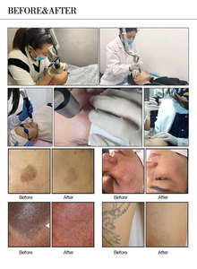 Máquina Láser de Picosegundos Nd Yag 1064 de Doble Pulso para Eliminación de Tatuajes y Equipo de Belleza con Láser para Medicina Estética - Product Image 6