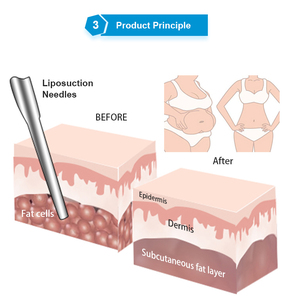Máquina de Liposucción al Vacío Vertical con Masaje con Rodillos, Drenaje Linfático, Moldeamiento Corporal, Equipo de Endermología para la Pérdida de Grasa - Product Image 3