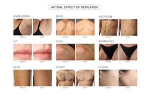 Eos ICE 1000w 다이오드 레이저 제모 1064 755 808 Diodo 3 파장 헤어 분석기와 제모 장치 - Product Image 5