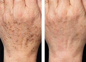 미국 510k 승인 <span class=keywords><strong>IPL</strong></span> 광안면 피부 회춘 SR HR 제모 기계 - Product Image 6