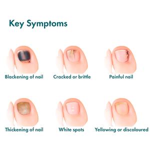 Vente Directe d'Usine Patch de Soin pour l'Inflammation Traitement Antifongique Renforçant les Patchs pour Ongles Abîmés - Product Image 6