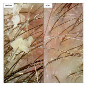 Shampoo <span class=keywords><strong>anti</strong></span>-<span class=keywords><strong>poux</strong></span>, traitement contre les <span class=keywords><strong>poux</strong></span>, défense quotidienne sans pesticide, shampooing <span class=keywords><strong>anti</strong></span>-<span class=keywords><strong>poux</strong></span> - Product Image 6