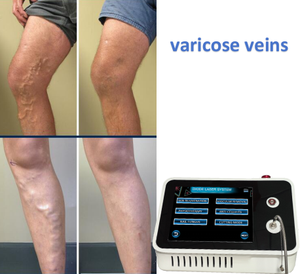 Harga terbaik Evlt mesin Laser endovenosa 1470nm perawatan untuk menghilangkan endocus Onychomycosis 980nm cahaya merah terapi kaki - Product Image 2