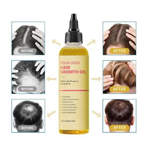 Tiktok Hot Selling Scalp <strong>Treatment</strong> Organic Herbal <strong>Hair</strong> Growth Oil <strong>Hair</strong> Growth Oil in <strong>India</strong> Product Range for <strong>Hair</strong> Growth
