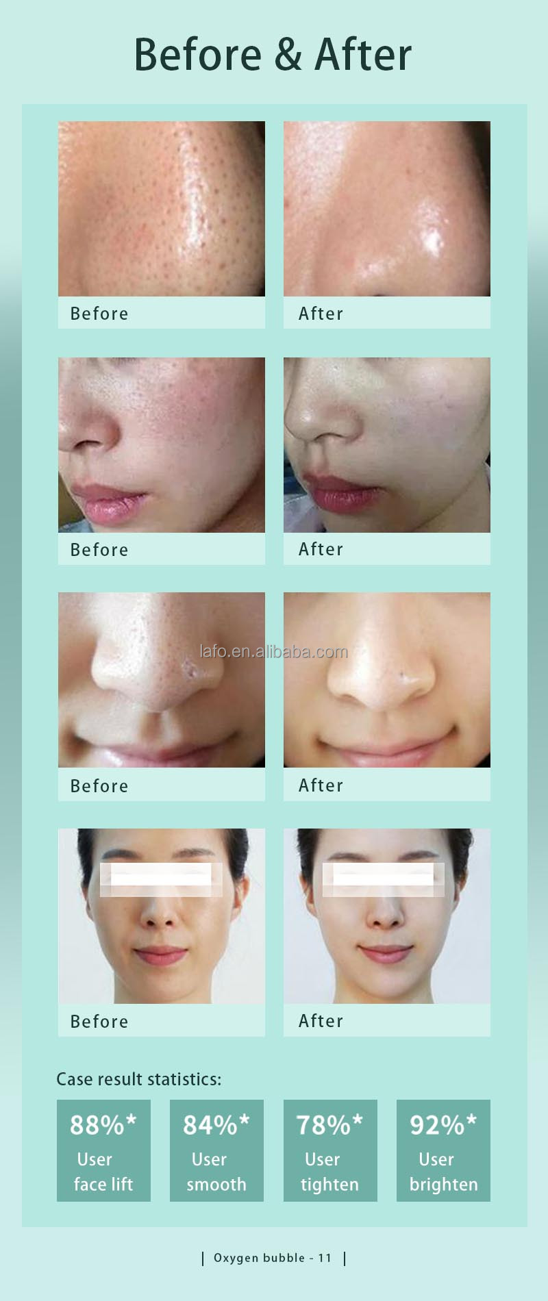 Hydra Aqua Facial Dermabrasion Machine Hydradermabrasion Skin Cleaning Face Lifting machine
