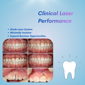 Dispositivo Láser Dental Eléctrico GIGAA VELAS II con Tecnología de Múltiples Longitudes de Onda para Estomatología, Cuidado Bucal y Tratamiento - Product Image 6