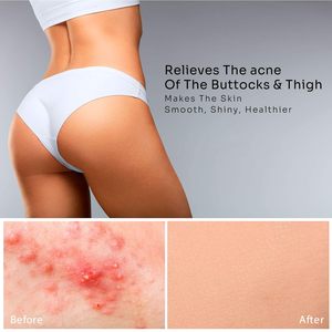 Crema para el acné a base de hierbas orgánicas OEM de etiqueta privada, tratamiento de elevación removedor coreano con ingredientes blanqueadores - Product Image 2