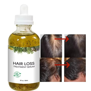 <span class=keywords><strong>Prodotti</strong></span> Naturali ed Erboristici <span class=keywords><strong>Biologici</strong></span> all'Ingrosso per la Cura del Cuoio Capelluto, Trattamento Anticaduta, Siero all'Olio di Rosmarino per la Crescita dei Capelli - Product Image 1