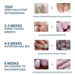 Pasta Curativa Suave para Uñas EELHOE, Suministro Efectivo para el Cuidado de las Uñas, Ayuda a Limpiar e Hidratar las Manos y los Pies - Product Image 3