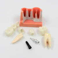 Modèle d'implant dentaire Éducation du patient Modèle dentaire Anatomie des dents Implant Couronne Pont Modèle de formation dentaire