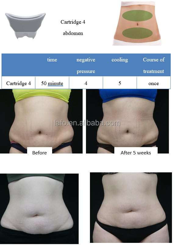 2022 360 cryolipolysis new technology professional body contouring fat reduce weight loss machine for sale LF-268