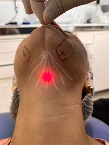 Portable Diode <strong>Laser</strong> 980nm 1470nm <strong>Machine</strong> for Liposuction Endoface Lifting Fiber Optic EVLT Weight Loss Beauty Personal Care - Product Image 5