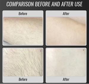 Uso profesional 15,6 pulgadas 755nm combinado 808nm Láser de Diodo 1064nm Láser de Diodo 3 ondas máquina de depilación - Product Image 6