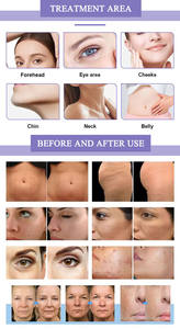 Nueva Máquina de Limpieza Facial Standing Morph Golden Pins 2026, Máquina de Cuidado de la Piel con Jet Peel, Antienvejecimiento, Eliminación de Arrugas y Estrías - Product Image 2