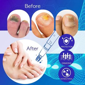 Stylo <span class=keywords><strong>antifongique</strong></span> à l'acide undécylénique à 25 %, 3 ml, soin des ongles pour les ongles craquelés et décolorés, à base de plantes, usage export - Product Image 2