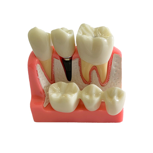 Modèle d'<span class=keywords><strong>implant</strong></span> <span class=keywords><strong>dentaire</strong></span> pour la démonstration patiente Modèle de <span class=keywords><strong>couronne</strong></span> et de pont d'<span class=keywords><strong>implant</strong></span> <span class=keywords><strong>dentaire</strong></span> - Product Image 5