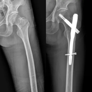 PFNA Intramedullary Nail System for Femur <strong>Fracture</strong>, Proximal <strong>Femoral</strong> Nail Antirotation for Orthopedic Trauma Surgery - Product Image 4