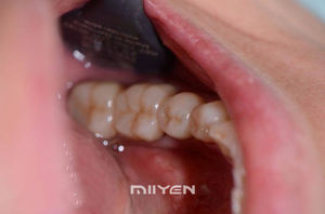 MIIYEN SHT multistrato AG sistema composito impiallacciatura denti fresatrice macchinari blocco Zirconia materiali dentali 10-30mm - Product Image 6