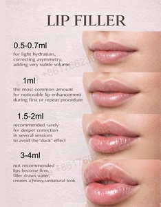 Acide hyaluronique réticulé injectable pour embellir les lèvres, effet naturel, pour un volume subtil des lèvres - Product Image 6