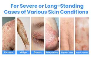 Lámpara Láser Excimer 308 de Kernel Medical, Fototerapia para Vitiligo, Dispositivo Láser Excimer para Tratamiento de Vitiligo KN-5000C - Product Image 2