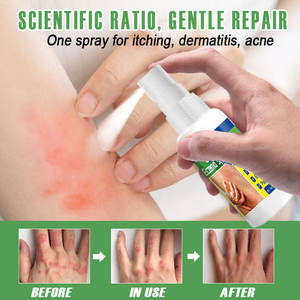 OEM Psoriasis <span class=keywords><strong>Eczema</strong></span> <span class=keywords><strong>Tratamiento</strong></span> Spray Athlete'foot Mano Tiña Dermatitis Antibacteriano Beriberi Anti Picazón Reparación Cuidado <span class=keywords><strong>DE</strong></span> LA PIEL - Product Image 2