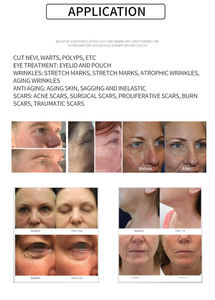 Máquina de Limpieza Facial de Plasma 2026, Dispositivo para Eliminar Cicatrices y Reafirmar la Piel, Compatible con Enchufes de EE. UU./Italia/Sudáfrica - Product Image 6