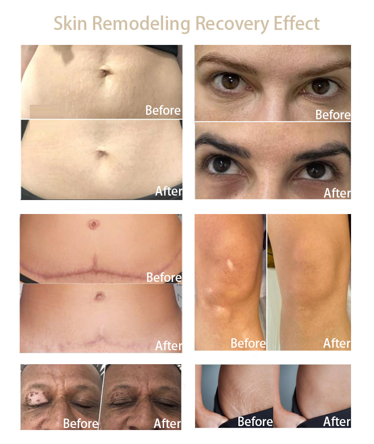 A pele permanente de NUOJO que remodela cicatrizes da tecnologia remove o pigmento da máquina do Vitiligo da tinta da tatuagem das marcas de estiramento