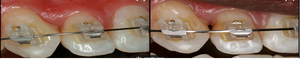 Gel Anticaries Seavue (Transparente en Envase de Plástico) 1ml, Certificado ISO 13485, Previene las Caries Dentales, Mejora la Erosión Ácida de los Dientes - Product Image 6