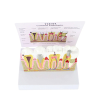 Modèle de pathologie dentaire Modèles de dents dentaires Modèle d'anatomie de la carie en plastique Équipement éducatif détachable médical Formation des dents