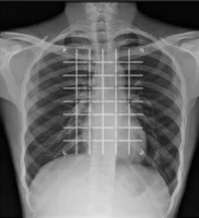 Grille de biopsie radiopaque pour imagerie CT, marqueurs d'imagerie radiopâques, grille adhésive, localisateur