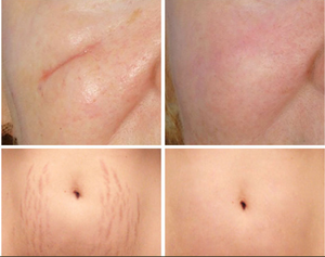 Etkili skar kaldırma yüz kremi akne sivilce streç işaretleri kaldırmak jel yumuşatma sıkılaştırıcı Anti streç işaretleri skar onarım krem - Product Image 5