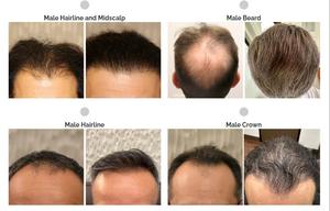 Equipo Médico de Alta Calidad para el Crecimiento del Cabello LLLT KN-8000A para la <span class=keywords><strong>Alopecia</strong></span> Androgenética y la <span class=keywords><strong>Alopecia</strong></span> <span class=keywords><strong>Areata</strong></span> - Product Image 4