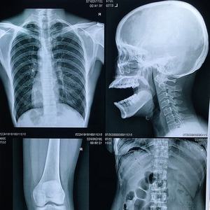 Película Médica de Impresión por Inyección de Tinta, Base Azul, Radiología Seca, Impresión de Rayos X, DR, CR, <span class=keywords><strong>CT</strong></span> - Product Image 6