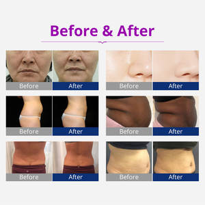 Máquina de Escultura Corporal 2026, 40K RF Multifunción, Quema Grasa, Cavitación, Portátil, Equipo de Belleza para Adelgazar el Cuerpo - Product Image 6